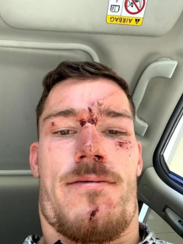 Supplied Editorial Canberra Raiders player Tom Starling after an incident with police on<em></em>
 the Central Coast. Picture supplied